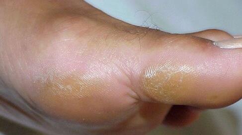 Callus on side of big toe