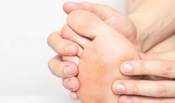 Get-Rid-of-Calluses