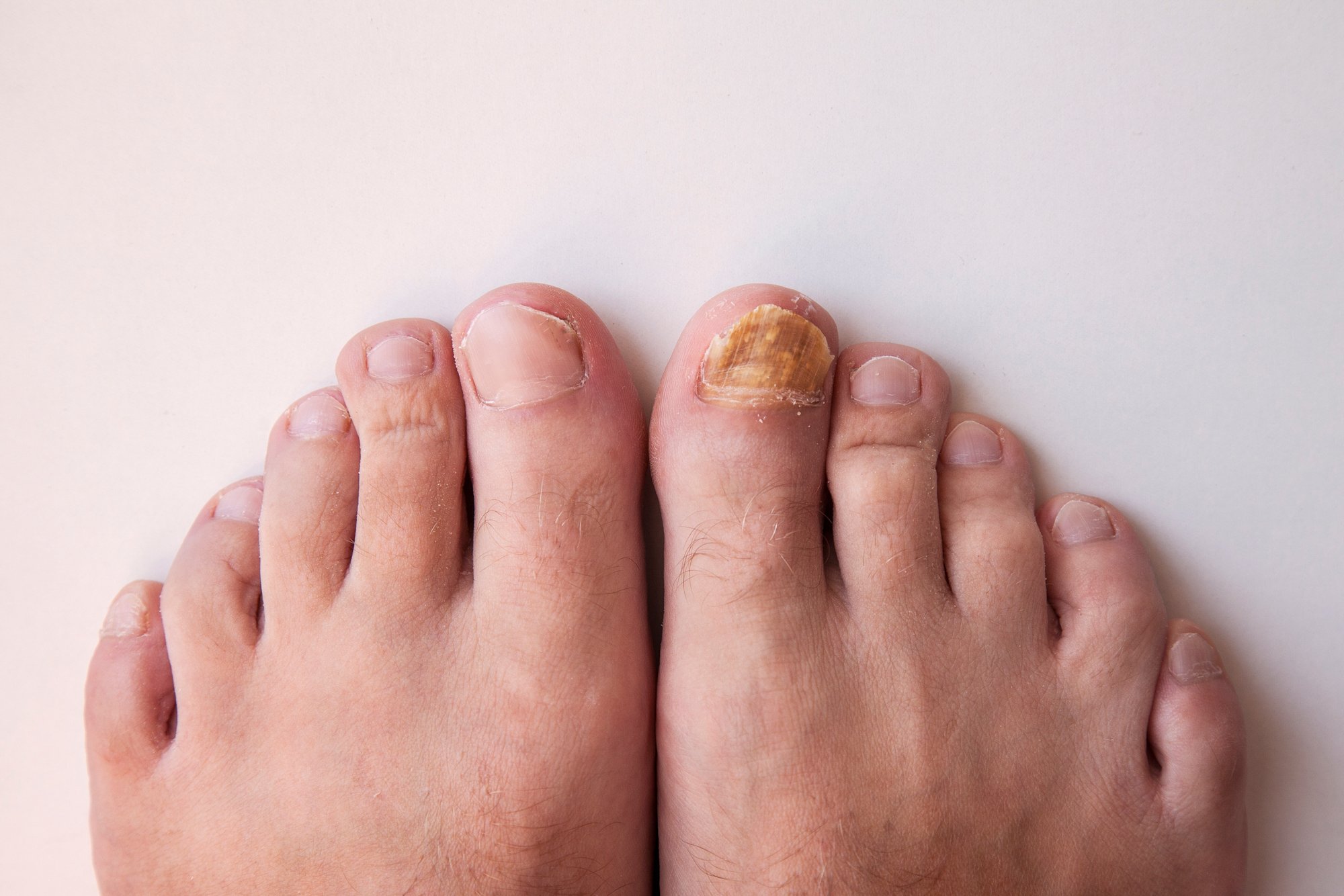 Home-Remedies-for-Toenail-Fungus