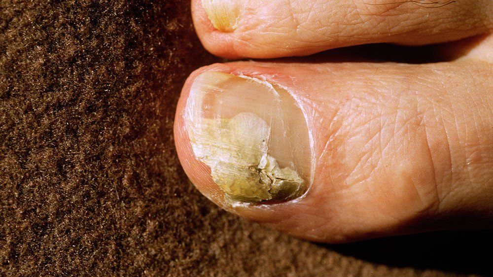 Home-Remedies-for-Toenail-Fungus