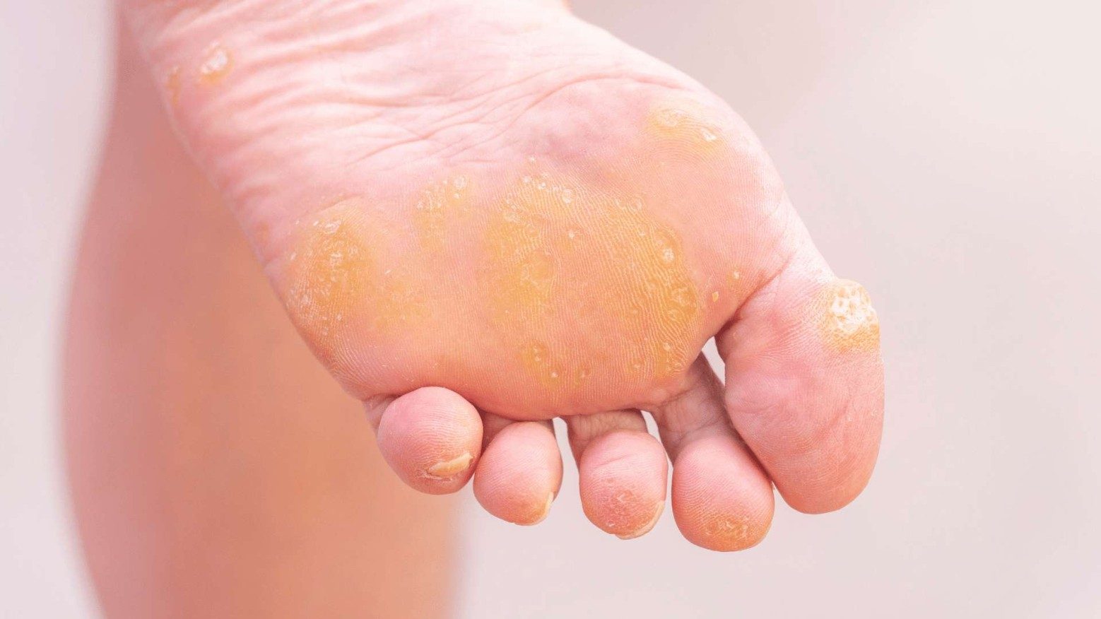 How to Prevent Calluses on Feet 