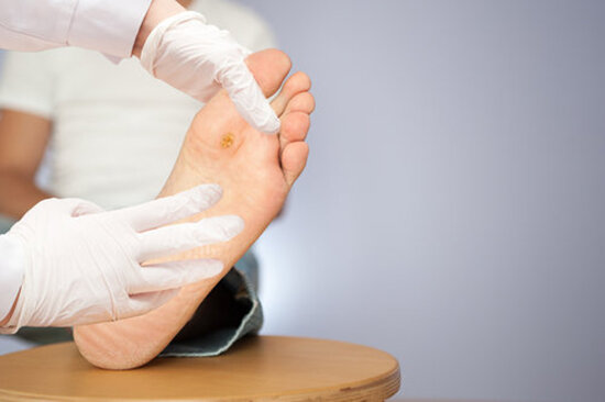 How to Prevent Calluses on Feet 