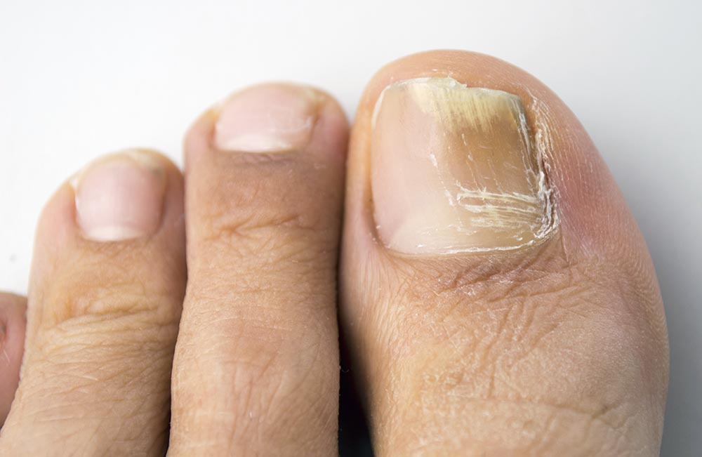 toenail fungus contagious