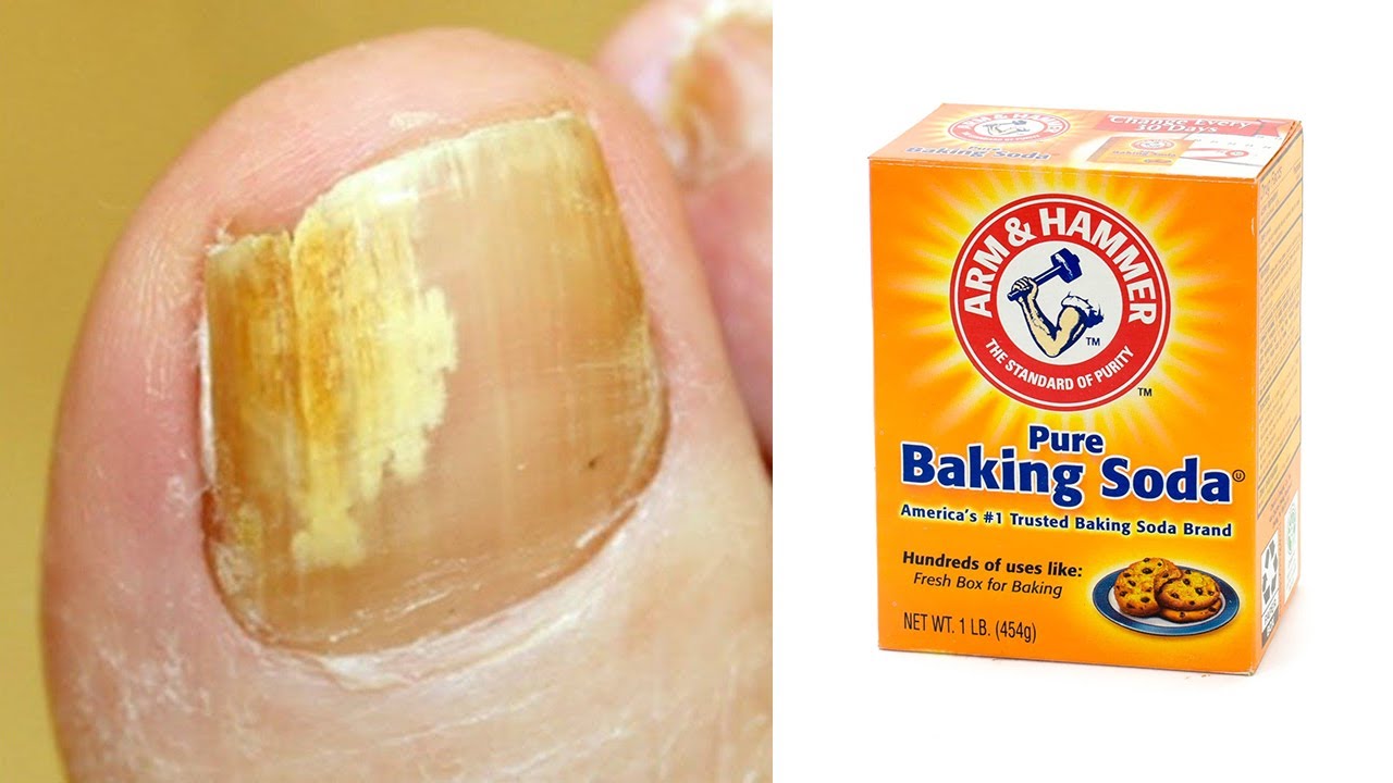 Natural-Remedies-for-Toenail-Fungus