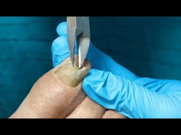 How To Cut Thick Toenails