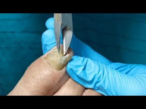 how-to-cut-thick-toenails