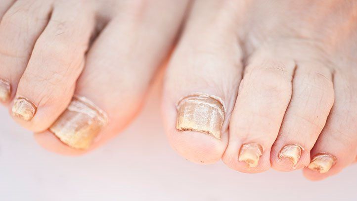 what-kills-toenail-fungus-instantly