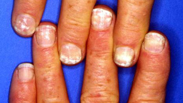 diseases for nail growth