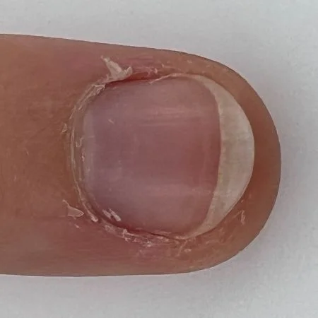 free edge of nail