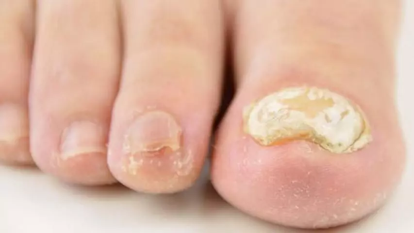 get rid of thick toenails 
