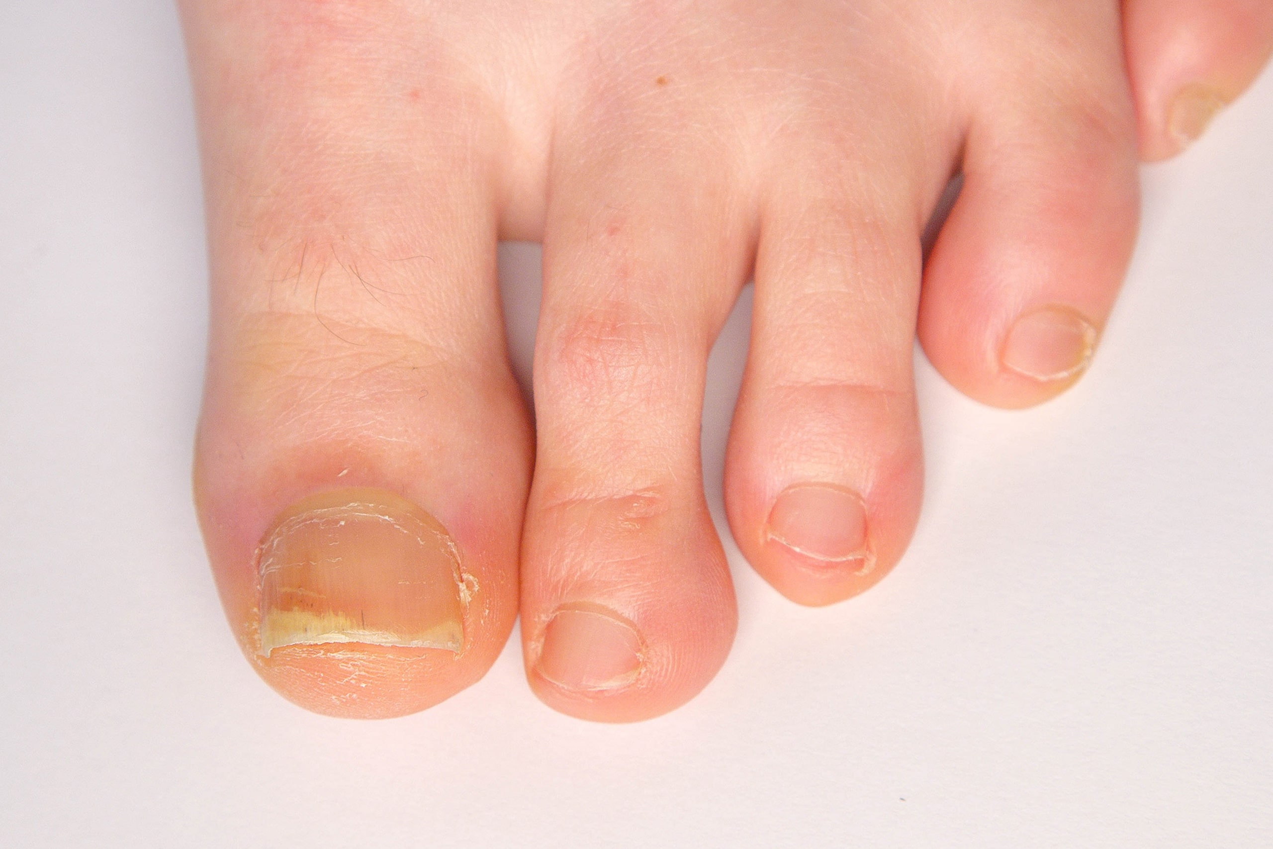 get rid of thick toenails 