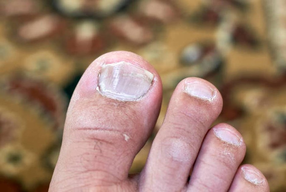 get rid of thick toenails