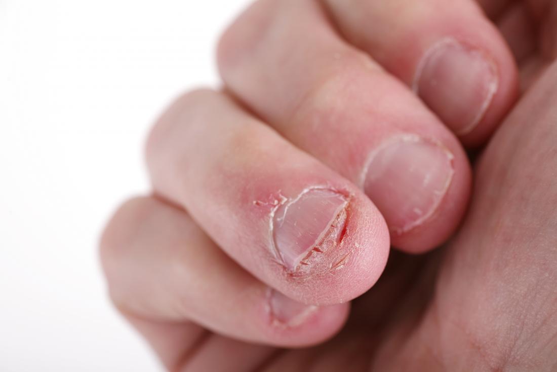 nail abnormalities
