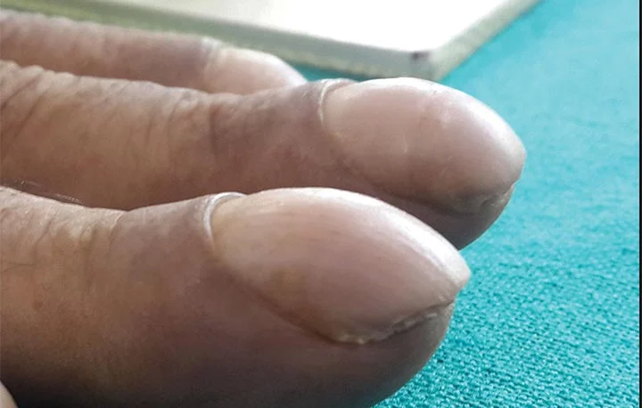 nail clubbing nail abnormalities