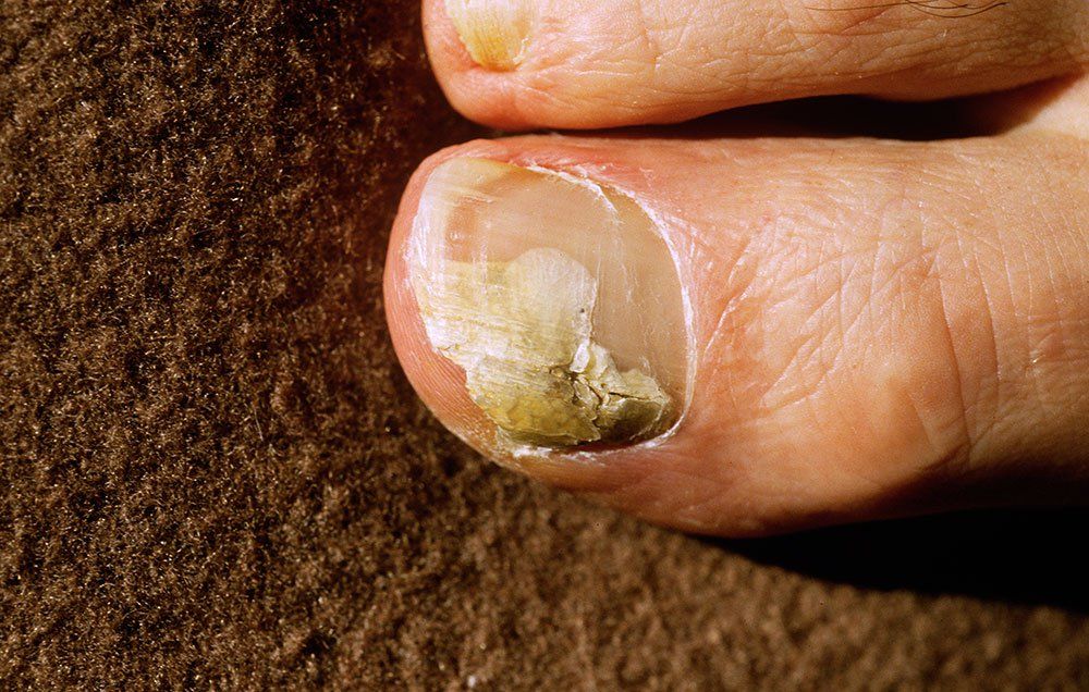 otc toenail fungus treatment