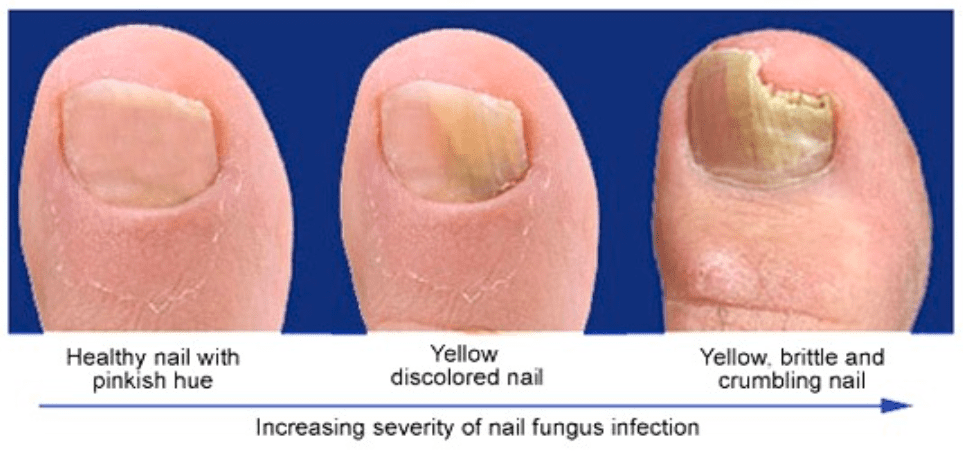 stages of toenail fungus