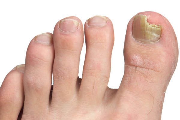 nail abnormalities toenail fungus