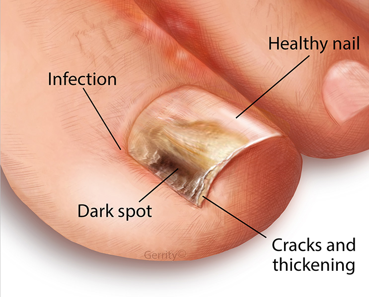 toenail fungus symptoms