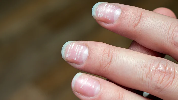 white spots on nails