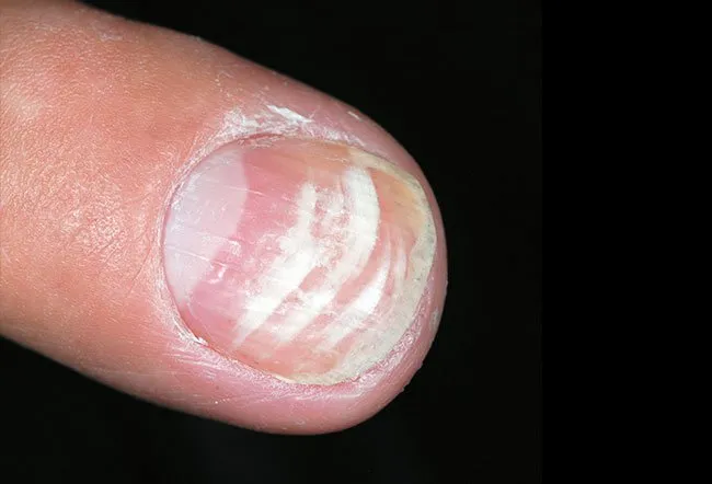 white spots on nails