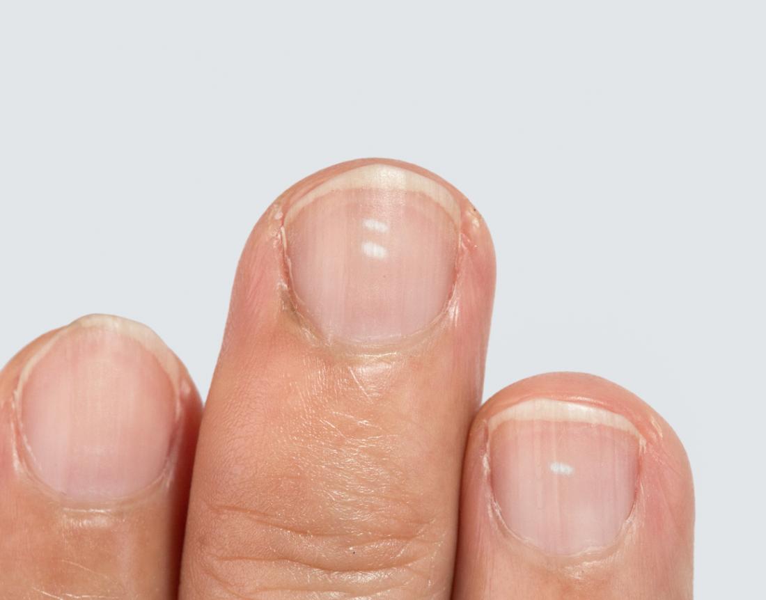 white spots on nails