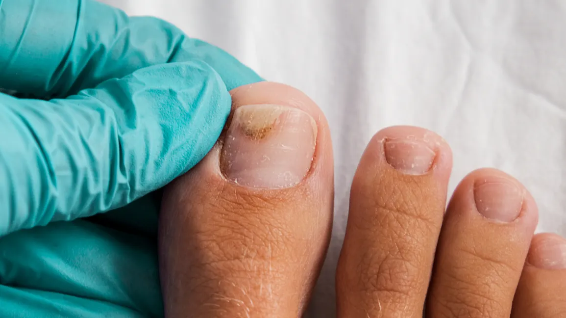 doctor treats toenail fungus