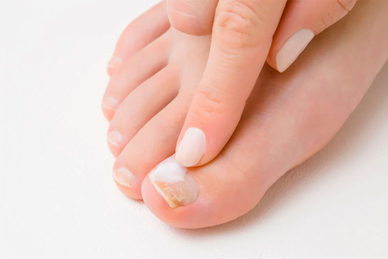 doctor treats toenail fungus