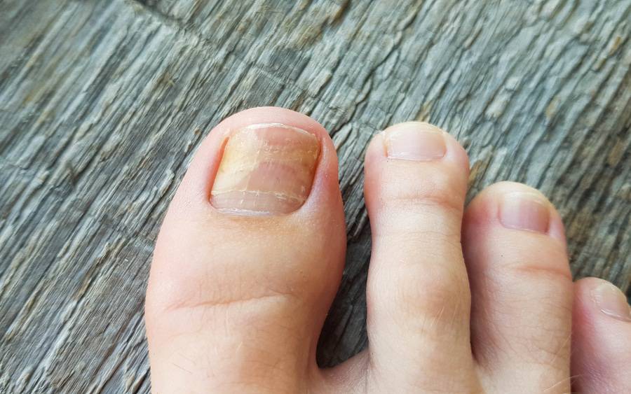 otc toenail fungus treatment