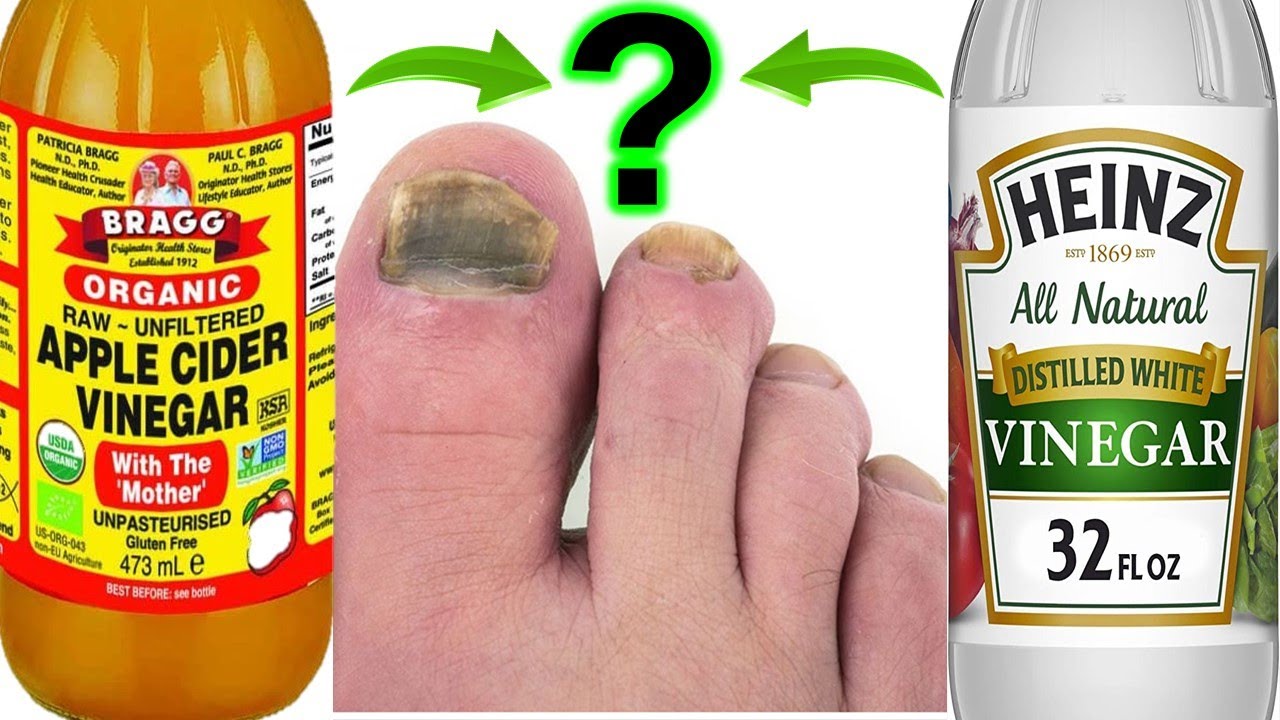 vinegar for toenail fungus