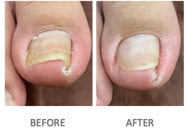ingrown toenail removal
