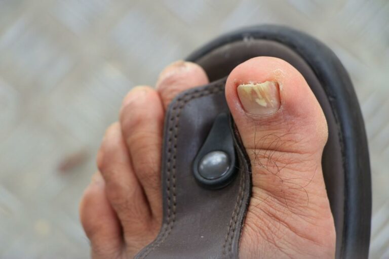 How to Wear Sandals with Toenail Fungus Steps to Confidence and Comfort