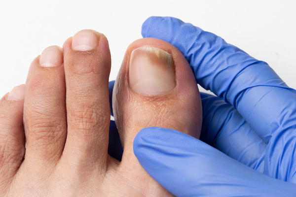 Wear Sandals with Toenail Fungus