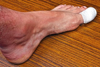 how-to-fix-ingrown-toenail