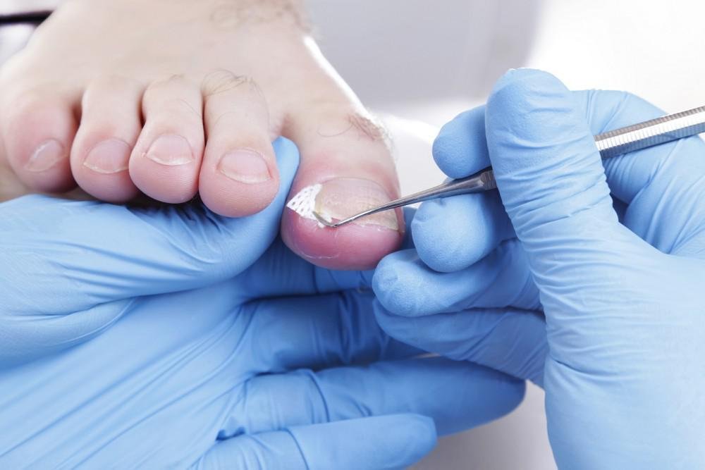 how-to-fix-ingrown-toenail