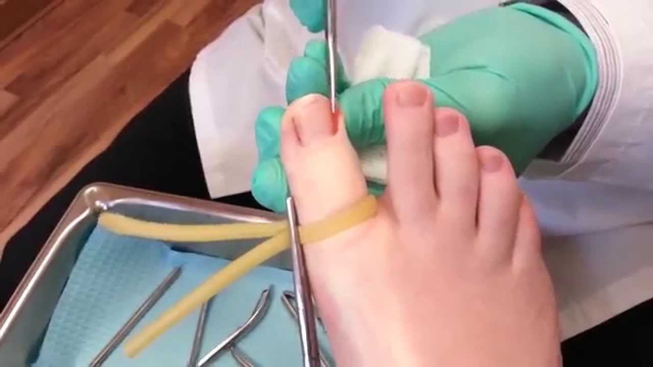 ingrown-toenail-removal