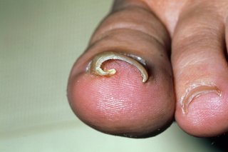 ingrown toenails