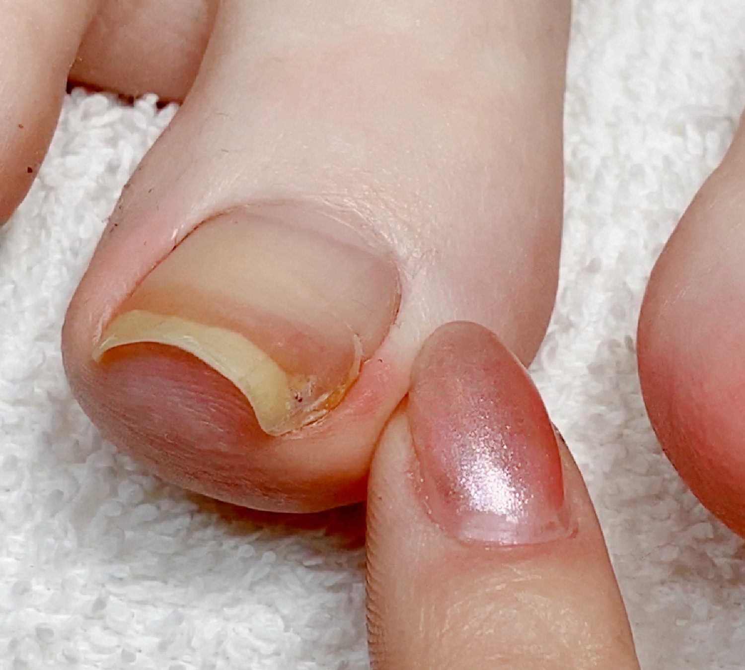 ingrown-toenails