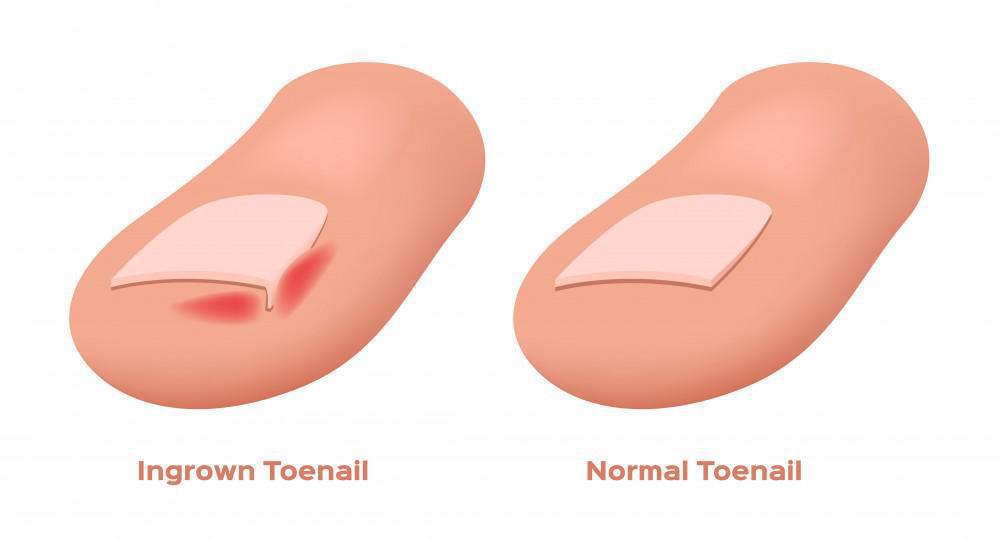 ingrown-toenails