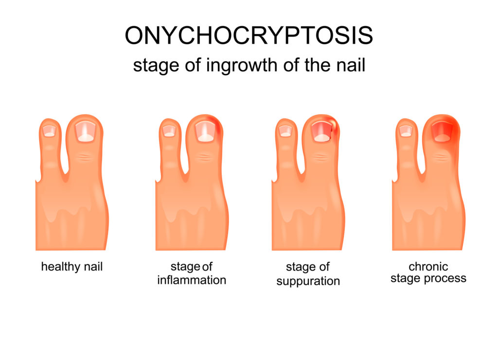 ingrown-toenails