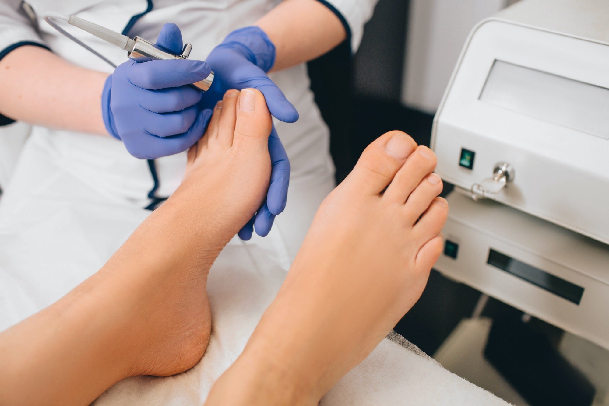 toenail-fungus-laser-treatment