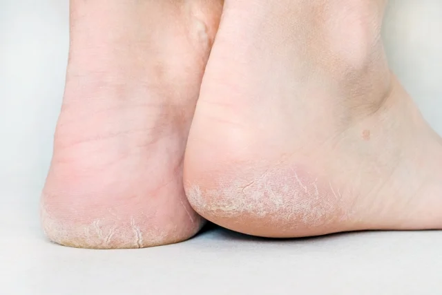 how to remove thick dead skin from feet