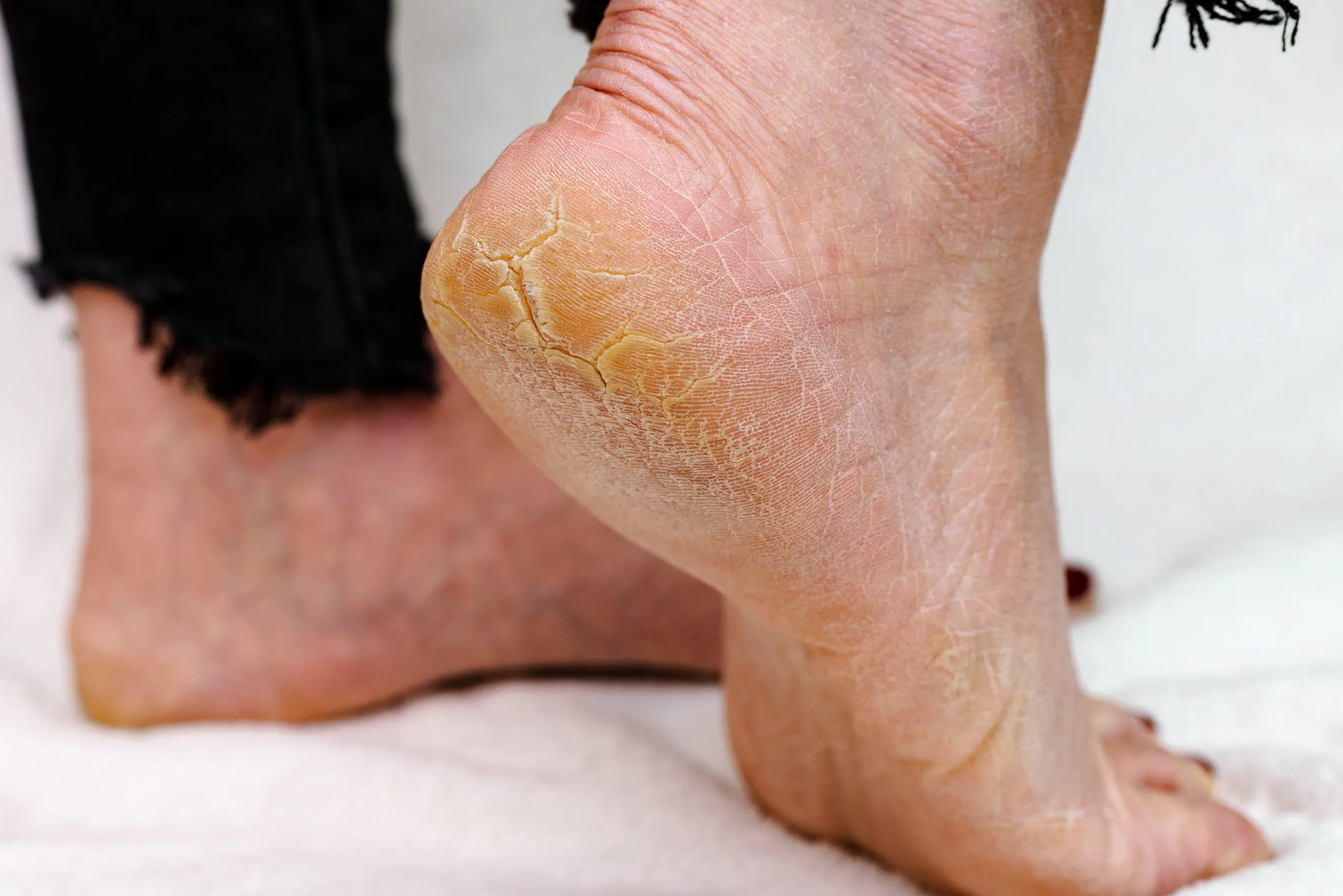 how to remove thick dead skin from feet