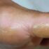 How to Prevent Calluses on Feet