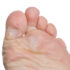 Callus on Side of Big Toe
