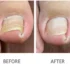 Will an ingrown toenail grow out on its own?