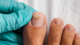 What Kind of Doctor Treats Toenail Fungus?