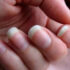 What Are The White Spots On My Nails?