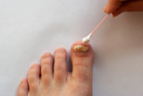 What Kills Toenail Fungus Instantly?